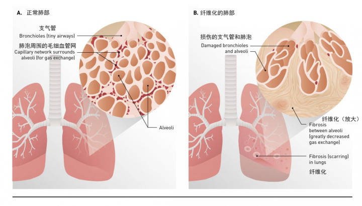 抽悦刻肺会纤维化吗？电子烟会导致肺纤维化吗？